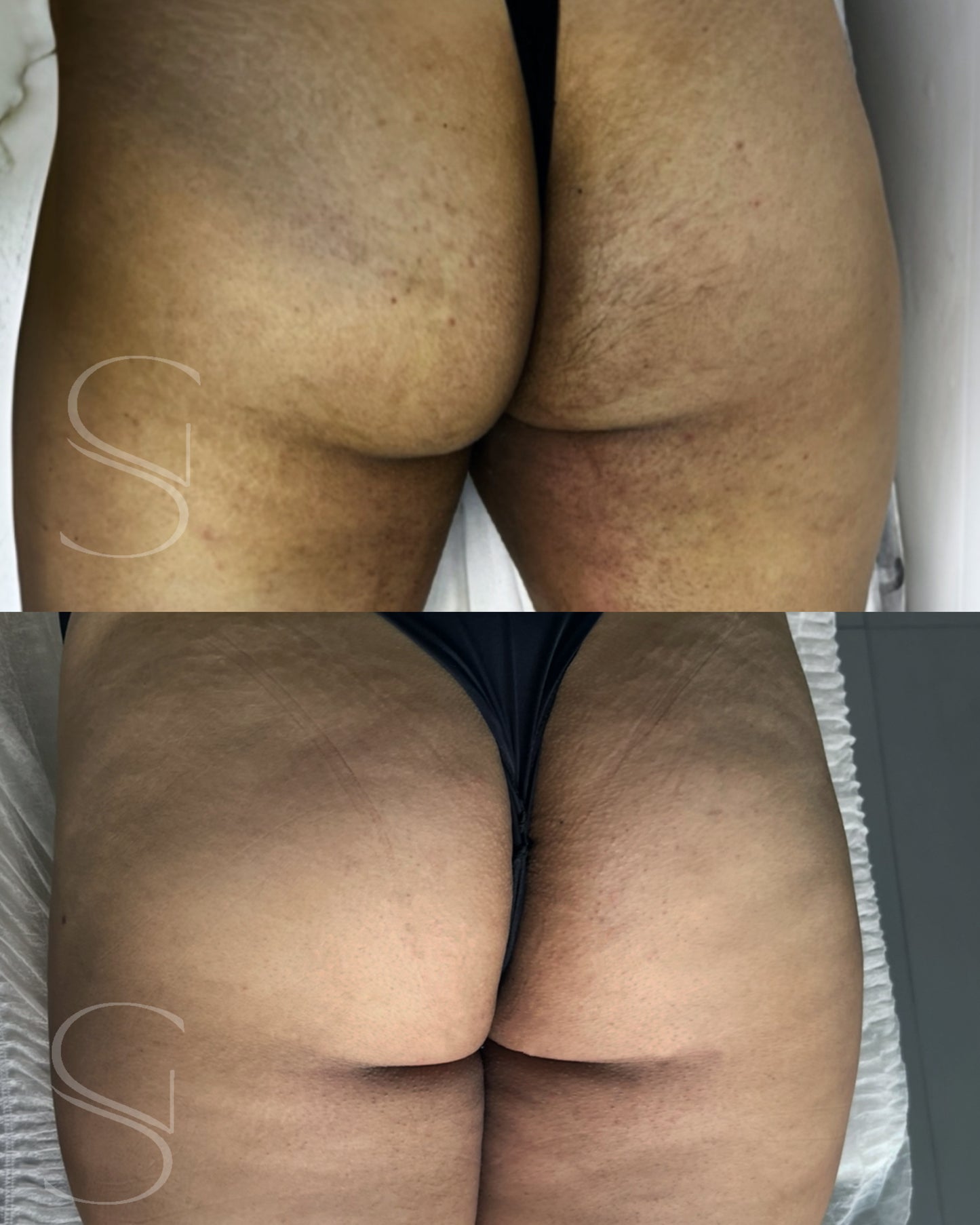 Clean Peel - Clareamento íntimo e corporal