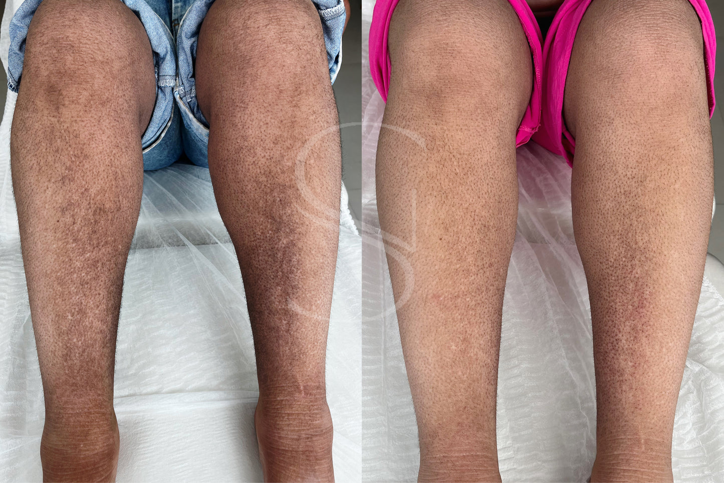 Clean Peel - Clareamento íntimo e corporal