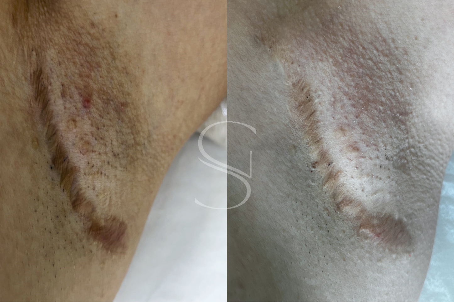 Clean Peel - Clareamento íntimo e corporal