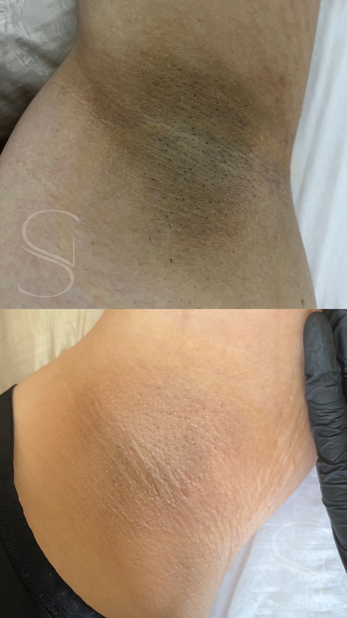 Clean Peel - Clareamento íntimo e corporal