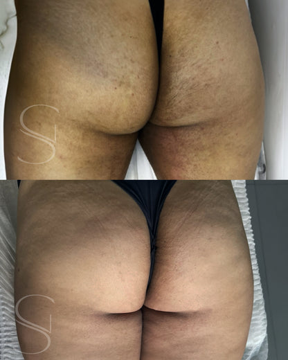 Clean Peel - Clareamento íntimo e corporal