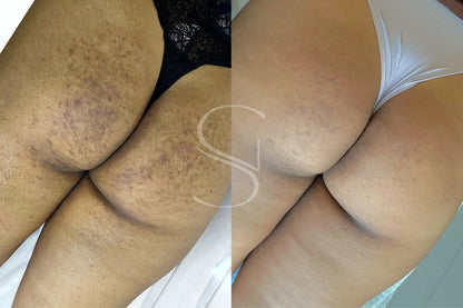 Clean Peel - Clareamento íntimo e corporal
